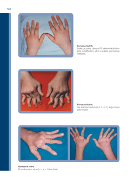 Romatoid Artrit: Başlangıç safha, bilateral PIF eklemlerde fusifom